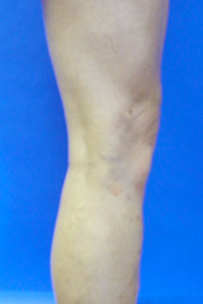 varicose spider vein removal ventura