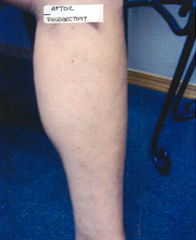 varicose spider vein removal ventura