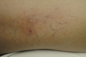 aslera injection varicose spider vein removal ventura