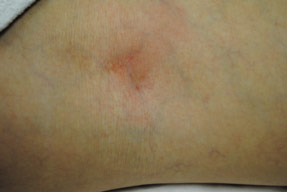 aslera injection varicose spider vein removal ventura