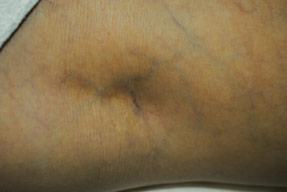 aslera injection varicose spider vein removal ventura