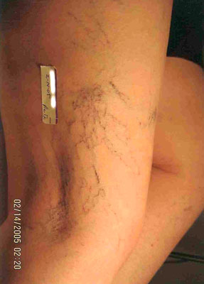 varicose spider vein removal ventura