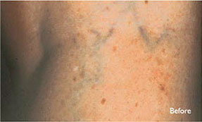 varicose spider vein removal ventura